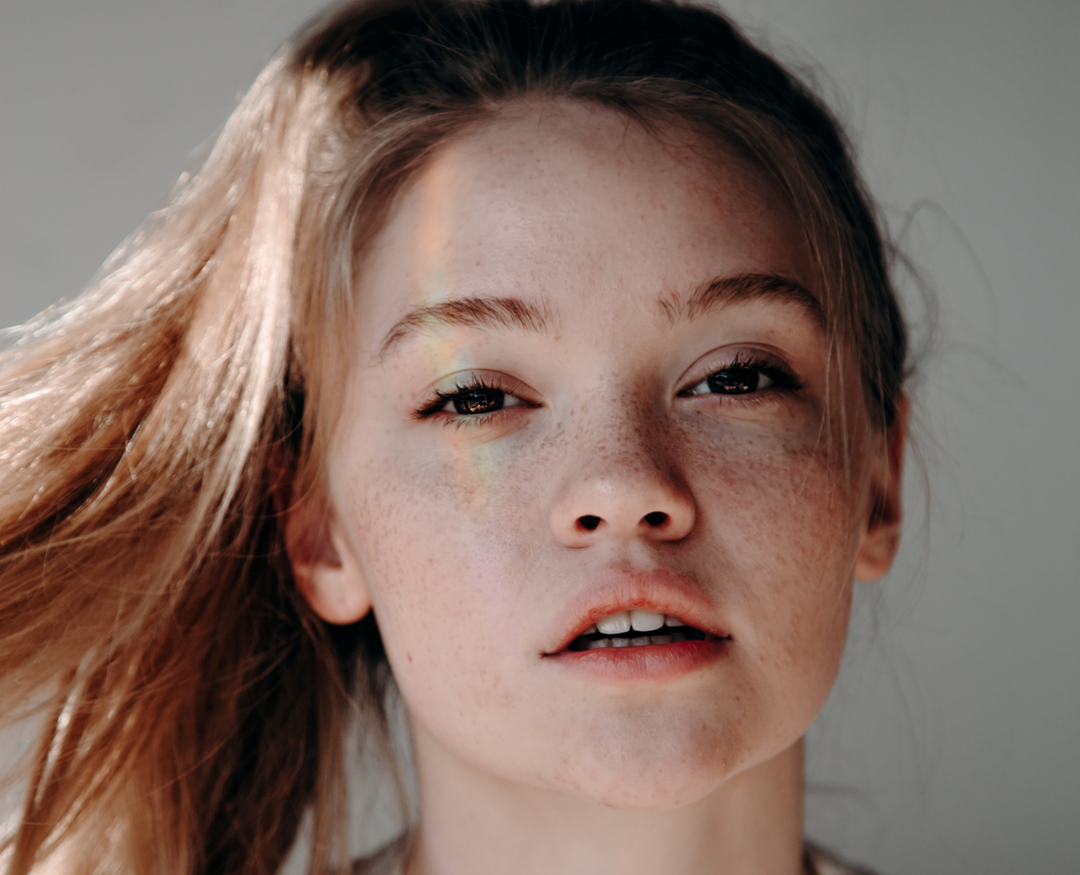 Young woman with freckles and hyperpigmentation 